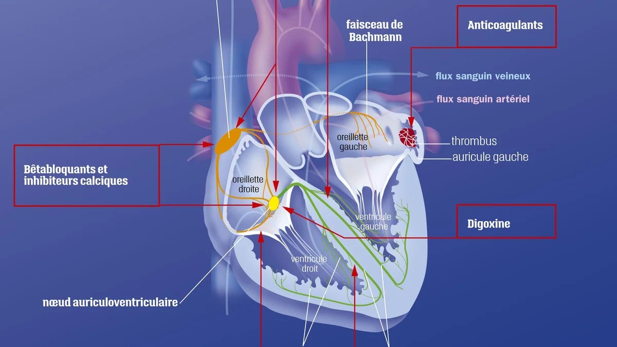 Tracé d'électrocardiogramme montrant une fibrillation auriculaire avec un rythme cardiaque irrégulier
